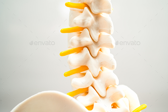 Lumbar spine displaced herniated disc fragment, spinal nerve and bone.