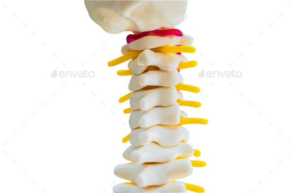 Lumbar spine displaced herniated disc fragment, spinal nerve and bone. Model on white background.