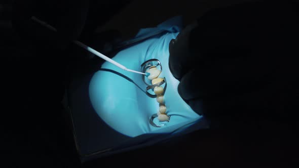 Dentist Installs Veneers To the Patient