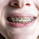 front view of dental braces on teeth of teenager - PhotoDune Item for Sale