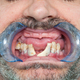 Rotten teeth during inspection with retractor for dental implant design. - PhotoDune Item for Sale