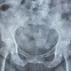 Hip xray. Human skeleton. Pelvis and femur bone. Osteoporosis - PhotoDune Item for Sale