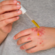 Patient hands applying rosehip oil on eczema. - PhotoDune Item for Sale