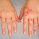 Patient hands with and without eczema comparison. - PhotoDune Item for Sale