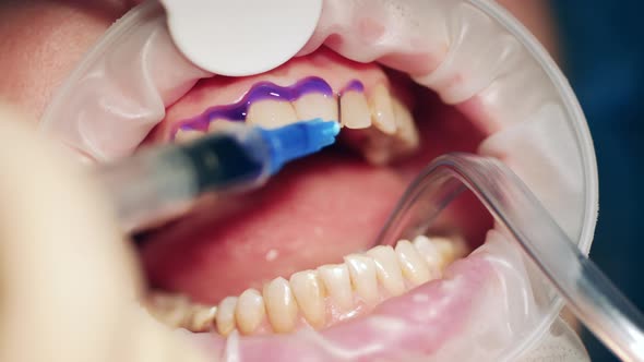 Close Up of Dental Medicine Getting Applied Onto Patient's Teeth alt