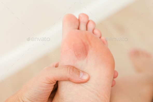 Close up mark from a callus on womans foot sole. Female is suffering from pain due to a corn on leg