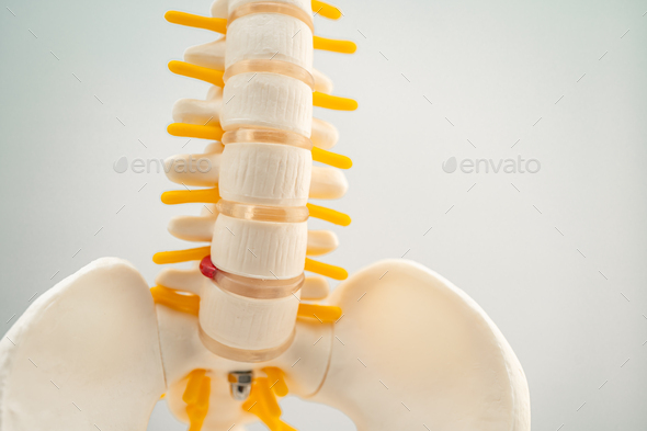 Lumbar spine displaced herniated disc fragment, spinal nerve and bone. Model for treatment medical