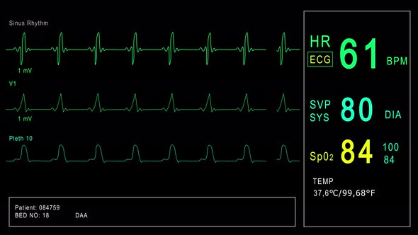 Looped: Patient Monitor Displays Vital Signs ECG Electrocardiogram EKG, Oxygen Saturation SPO2 and alt