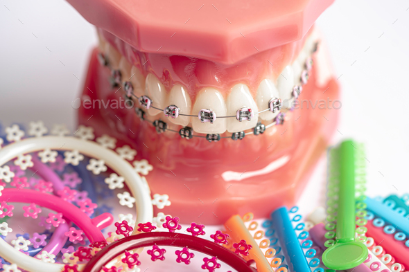 Orthodontic ligatures rings and ties, elastic rubber bands on orthodontic braces.