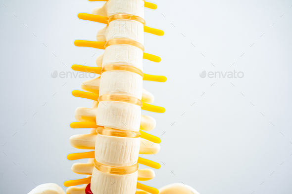 Lumbar spine displaced herniated disc fragment, spinal nerve and bone. Model
