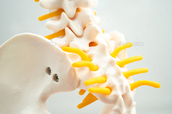 Lumbar spine displaced herniated disc fragment, spinal nerve and bone. Model for treatment medical