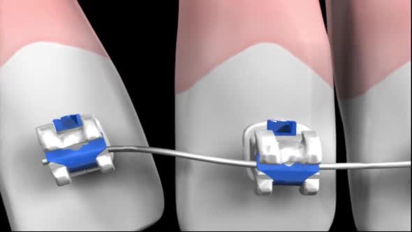 dental braces.mov alt