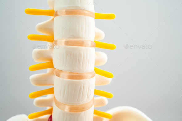 Lumbar spine displaced herniated disc fragment, spinal nerve and bone. Model for treatment medical.