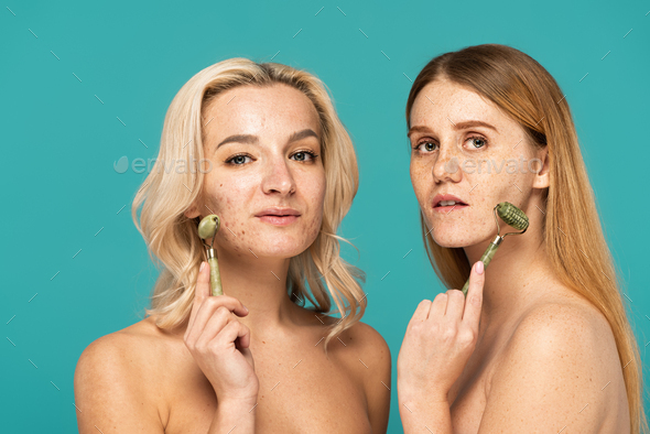 woman with acne and redhead model with freckles lifting faces with jade rollers isolated on