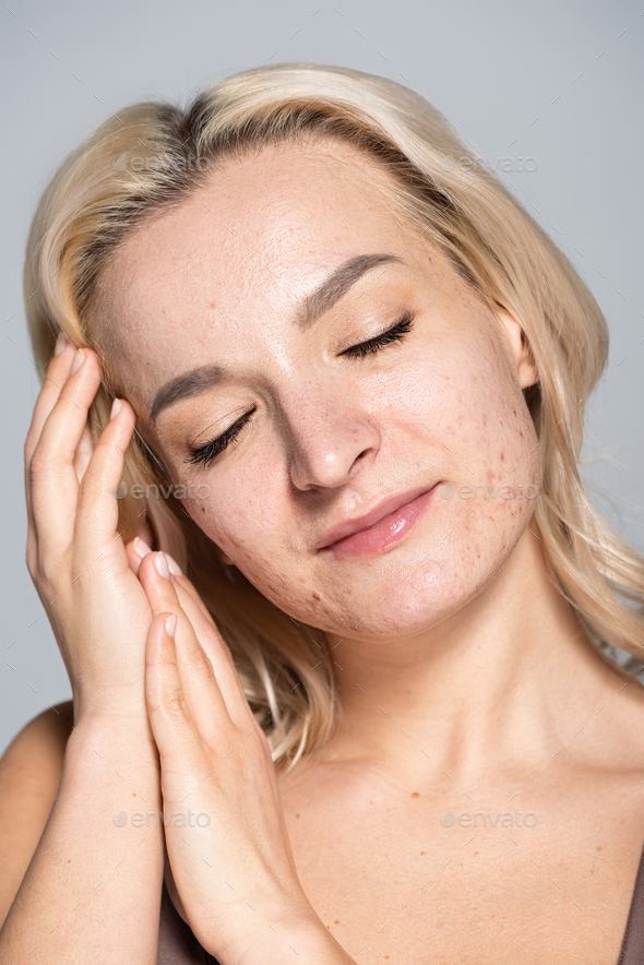 Blonde model with acne on problem skin posing isolated on grey