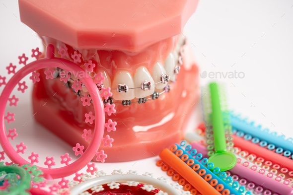 Orthodontic ligatures rings and ties, elastic rubber bands on orthodontic braces, model for dentist.