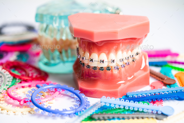 Orthodontic ligatures rings and ties, elastic rubber bands on orthodontic braces