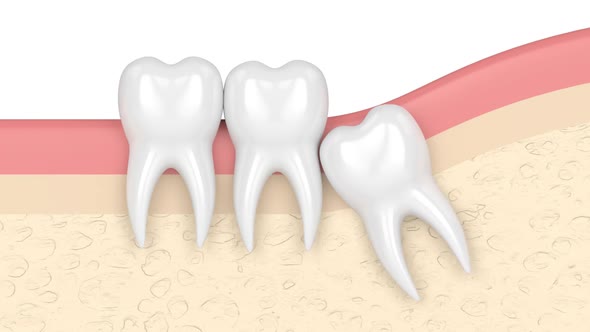 Gums with wisdom tooth mesial causing crowding alt