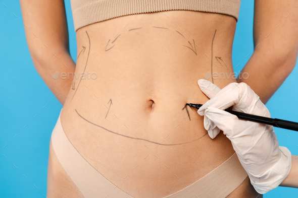 Female body before and after treatment. Plastic surgery. Stock Photo