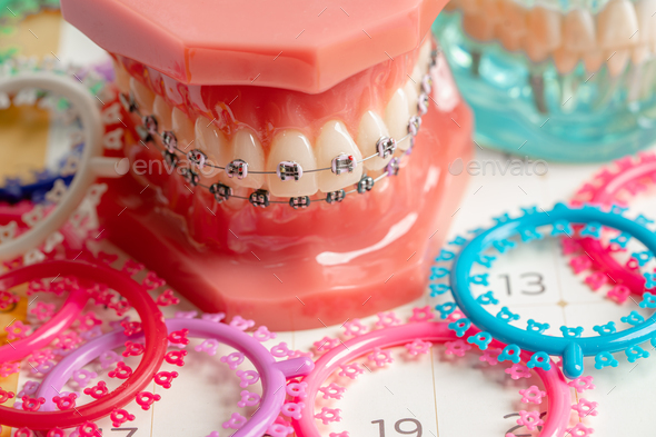 Orthodontic ligatures rings and ties, elastic rubber bands on orthodontic braces