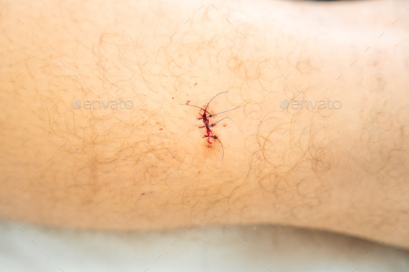 Fresh wound with stitches after skin operation