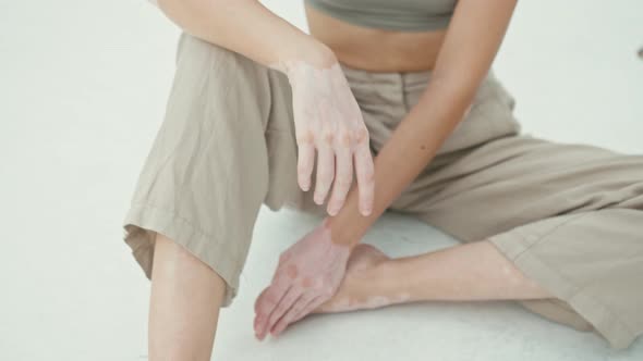 Pretty Young Woman with Vitiligo Pigmentation Sitting on the White Floor Looking at the Camera alt