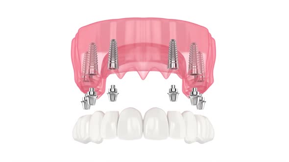 Upper jaw with prosthesis all-on-6 system supported by implants