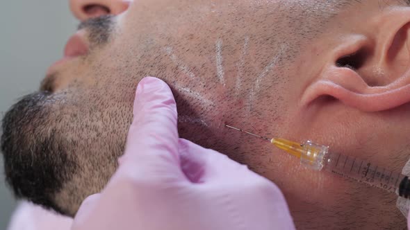 Cosmetic Injections for Men