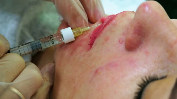 The Cosmetologist Makes Injections on the Client's Face in the Lip Area