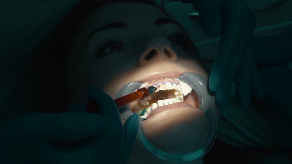 Application of Bleaching Gel for Procedure of Teeth Whitening alt