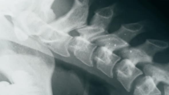 Neck Xray Closeup alt