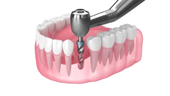Dental implant placement procedure over white background