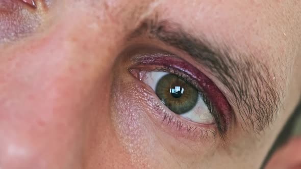 Real Black Eye on the Young Male Face Bruise on a Man Eyelid alt