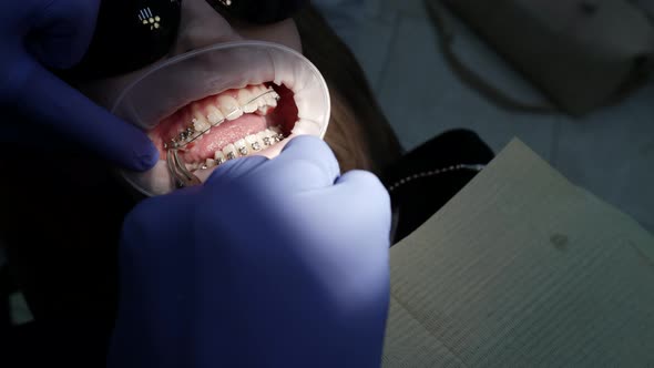 Orthodontic Specialist Is Fixing Dental Braces on Teeth of Female Patient in Clinic Closeup View alt