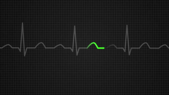 Animation of a diagram showing values for a death on electrocardiograph screen alt