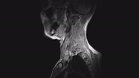 Voluminous MRI of the Cervical Spine, Detection of Protrusions and Hernias alt