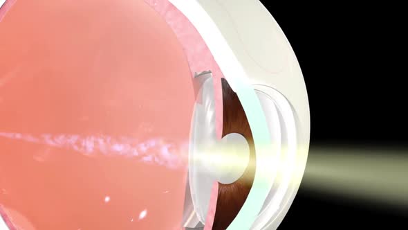 Anatomy of the Eye. Loss of vision in the eye alt