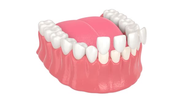 Jaw with installing dental veneers over white background