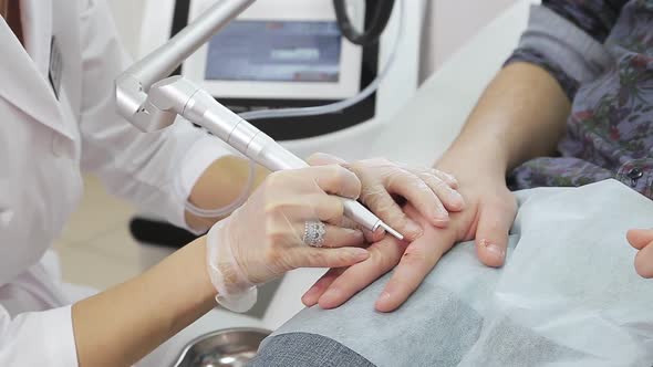 Removal of Warts Laser on the Fingers alt