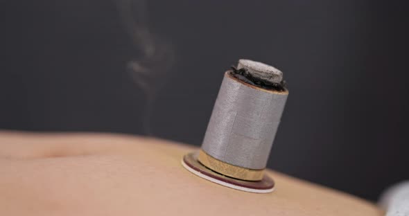 Chinese medicine moxibustion therapy  alt