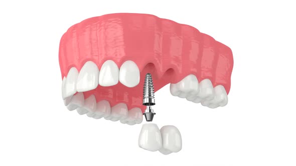 Upper jaw with implant supported dental cantilever bridge isolated over white