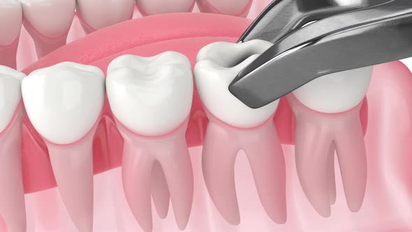 Tooth growth problems caused by the lack of space maintainer between teeth