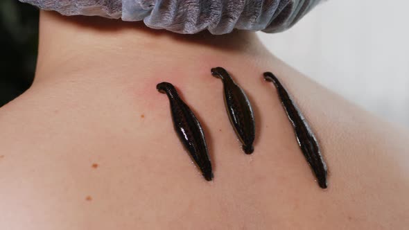 Three Leeches on Patient's Neck Closeup