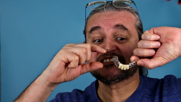 Patient Dental Holds Temporary Crowns Taken From with Analogues of Implants alt