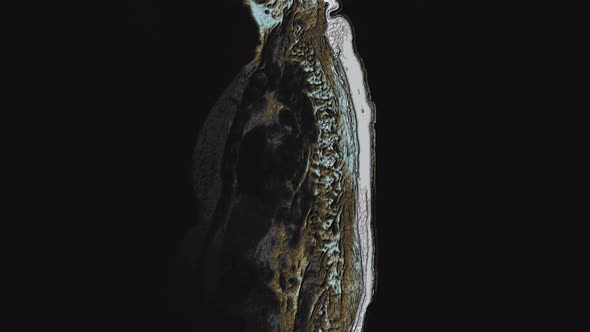 Postoperative Bulk Multicolored MRI of Female Organs for the Detection of Metastases alt