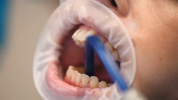 Dentist Prepares Patient's Teeth