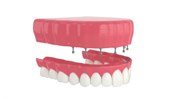 Removable snap-on full implant denture installation