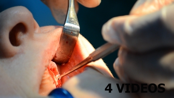 Dental Surgery 02 - 4 Videos