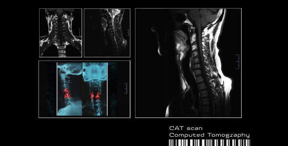CT Scan of Neck and Cerebellum