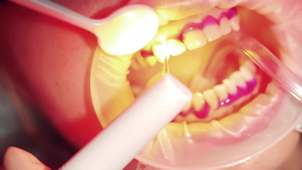 Close Up of Teeth Undergoing Oral Hygiene Procedure alt